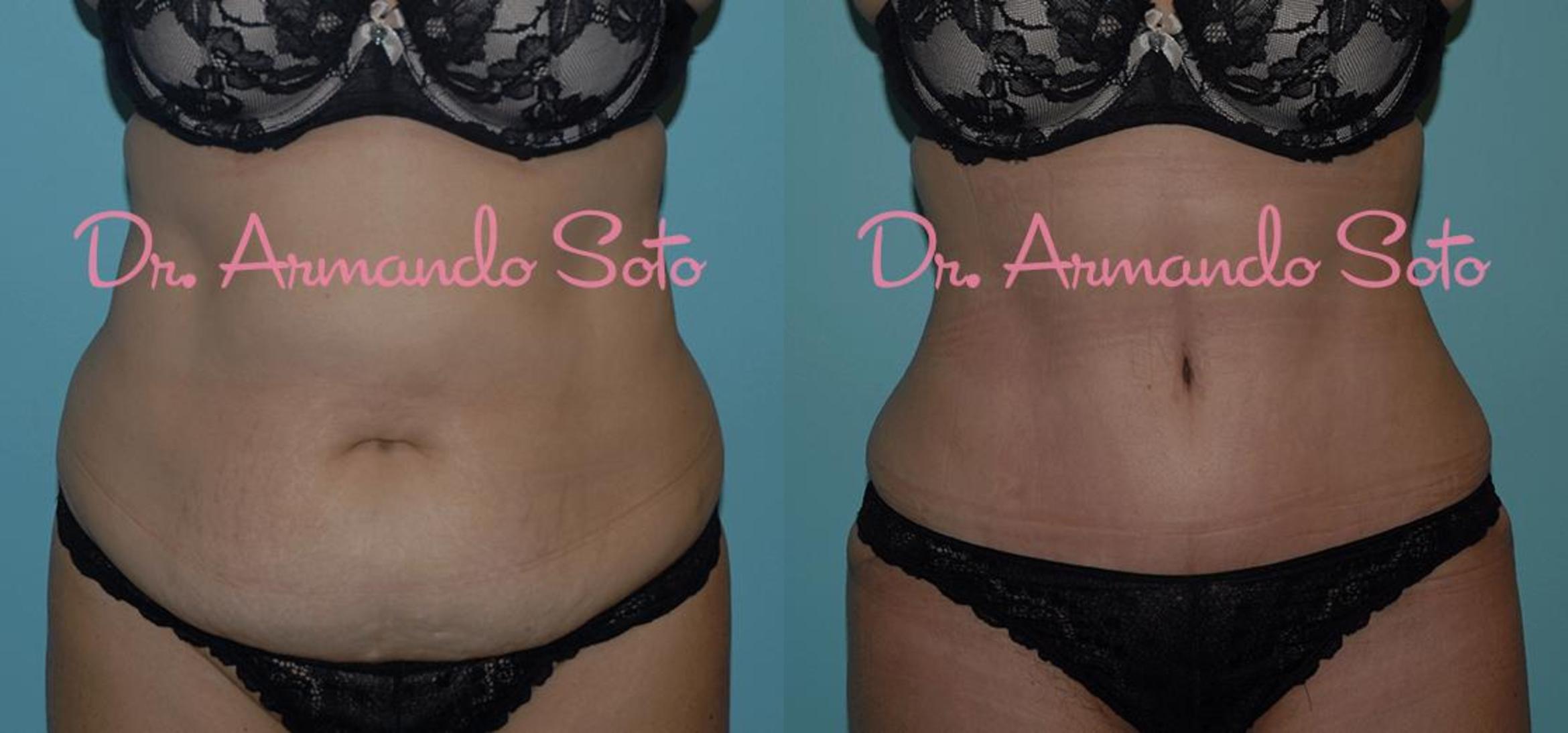 Before & After Tummy Tuck Case 23317 View #1 View in Orlando, FL