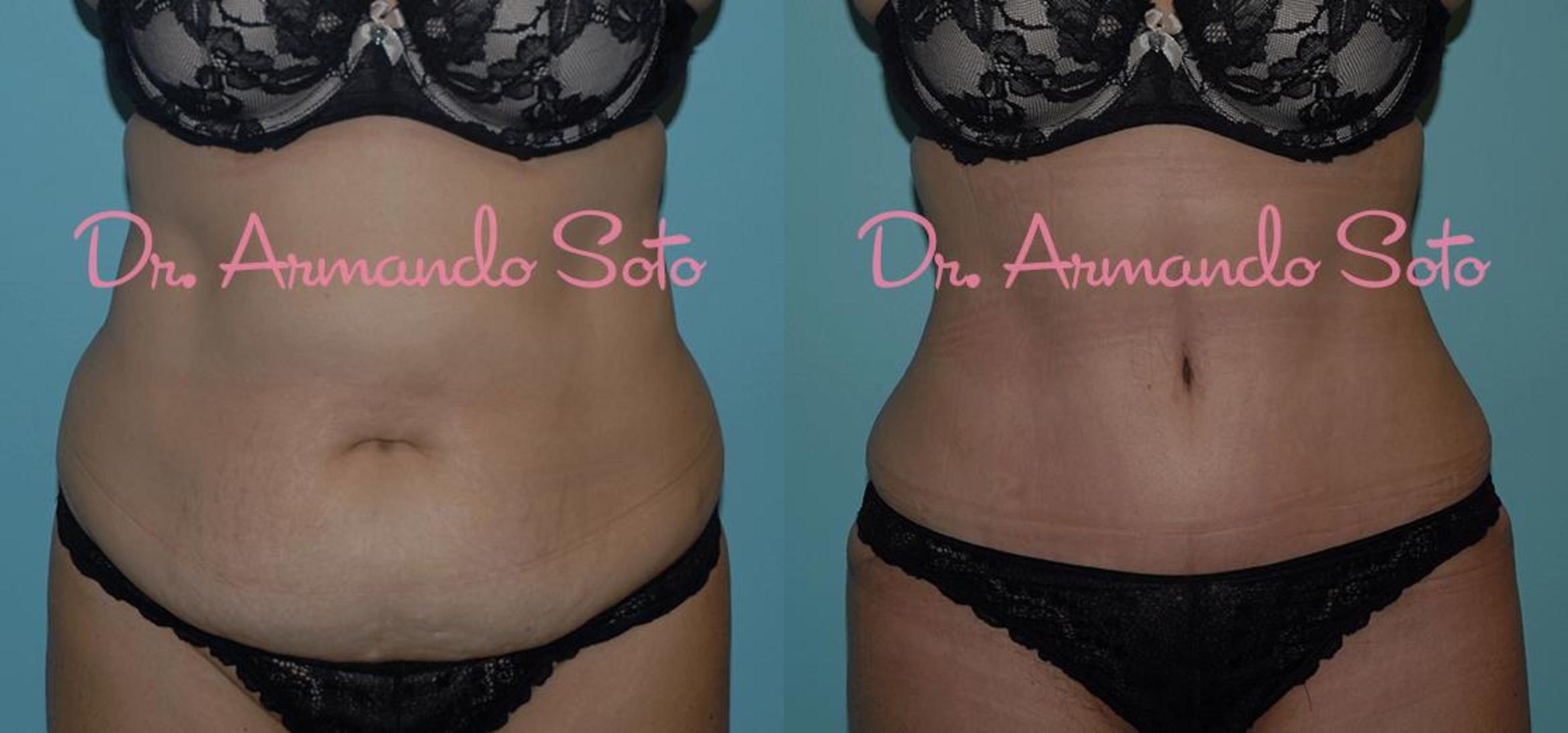 Dos and Don'ts for Tummy Tuck Surgery - Orlando FL - The Institute