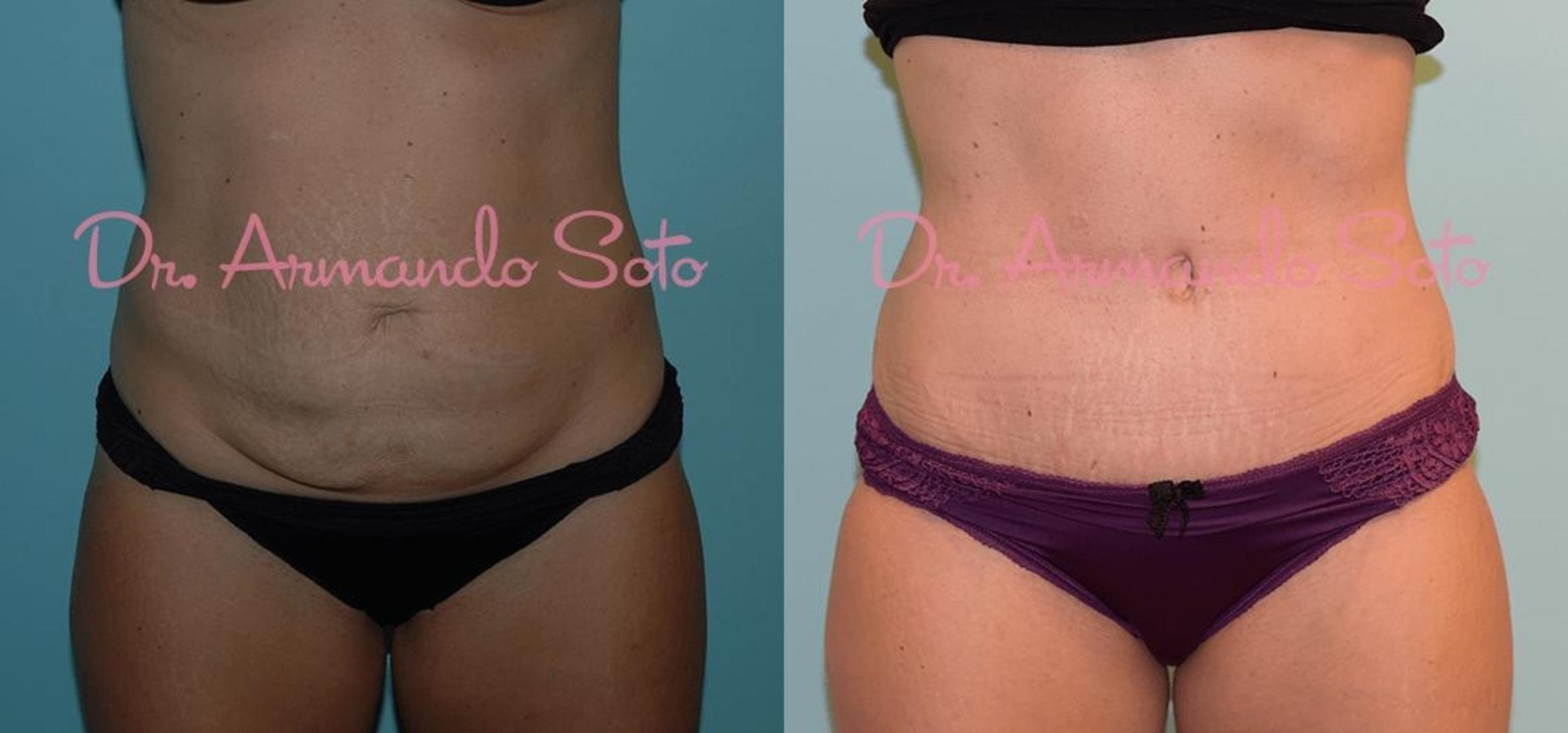 Before & After Tummy Tuck Case 23377 View #1 View in Orlando, FL