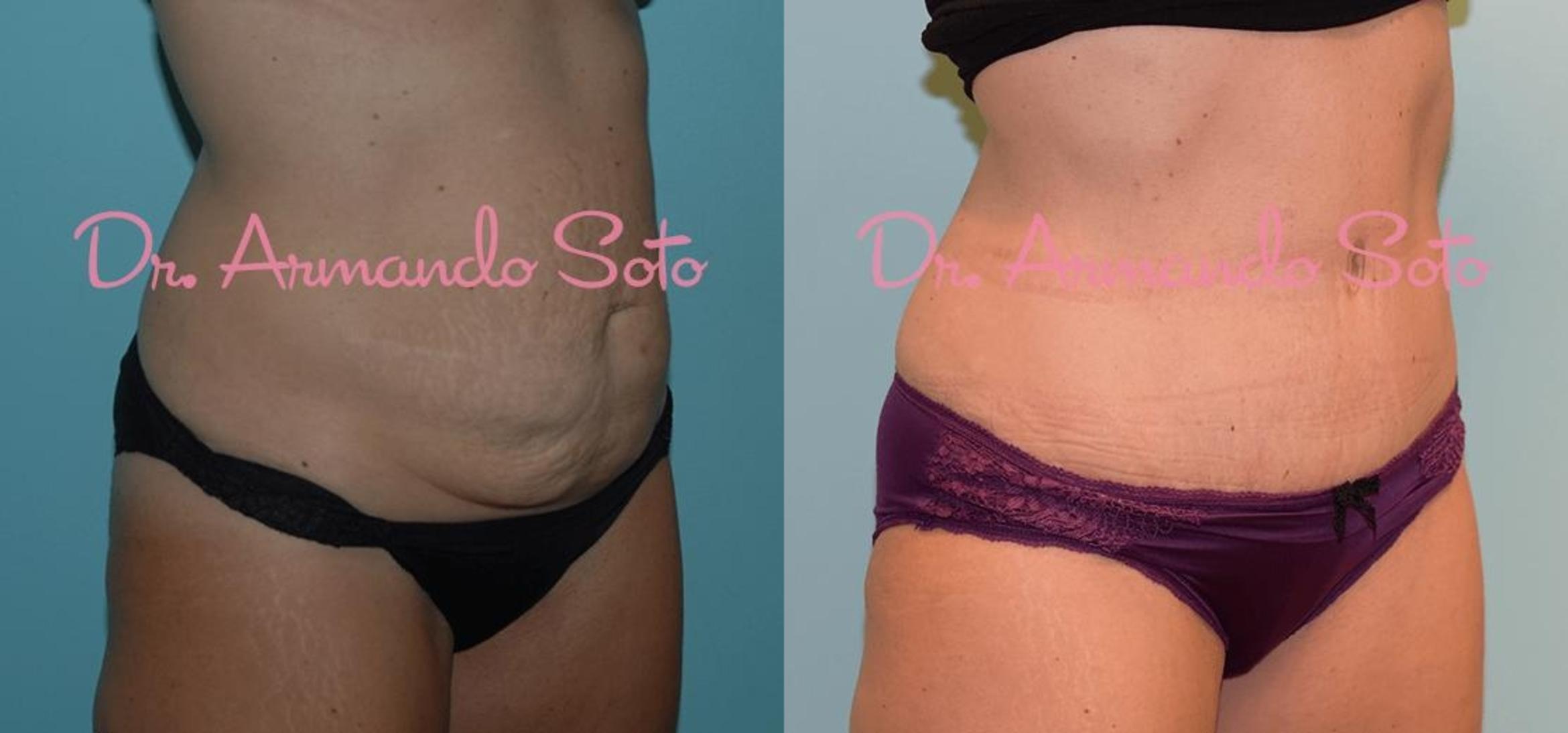 Before & After Tummy Tuck Case 23377 View #2 View in Orlando, FL