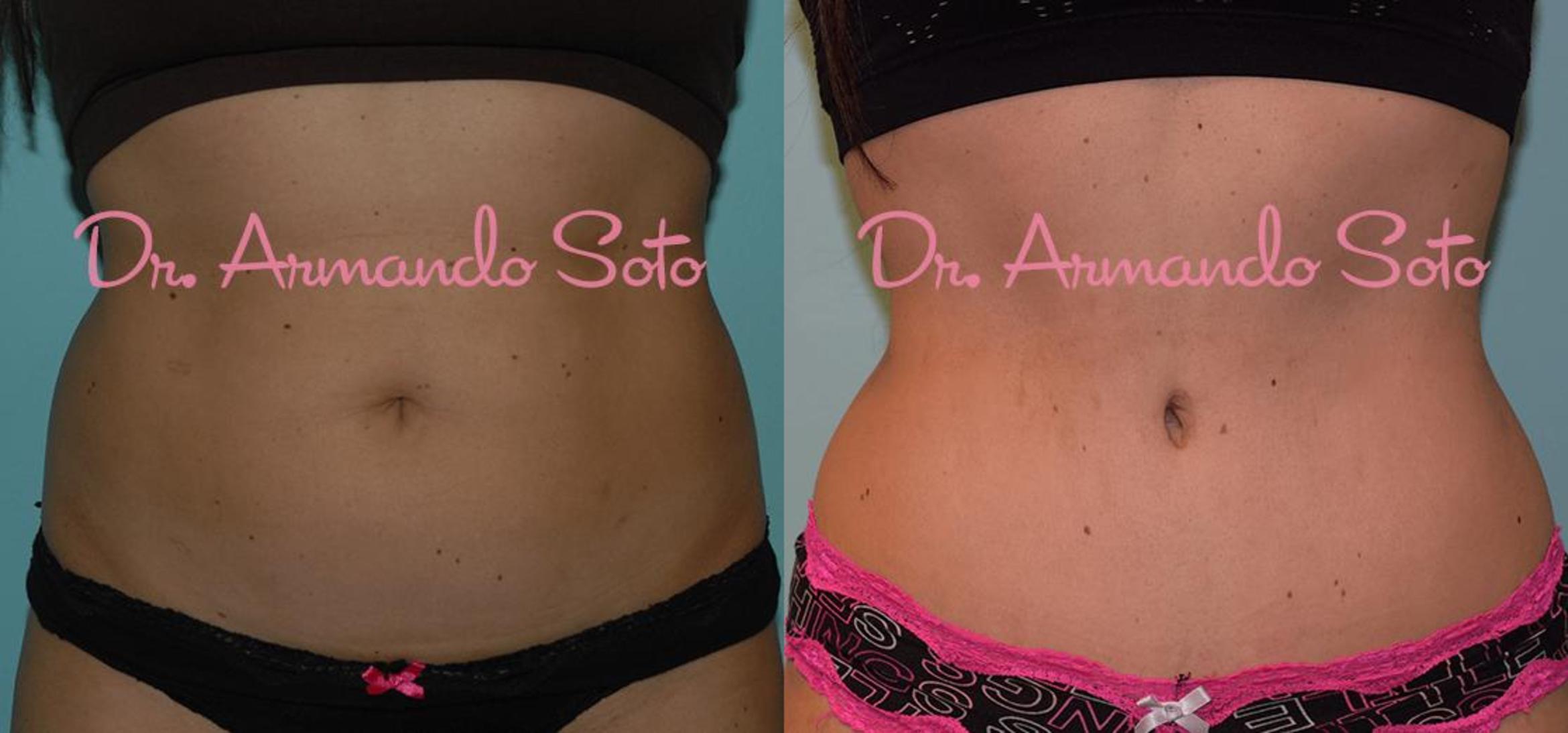Before & After Tummy Tuck Case 23378 View #1 View in Orlando, FL