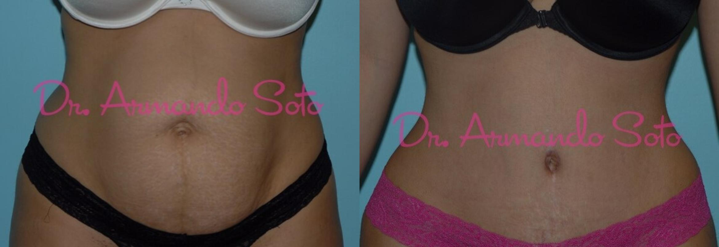 Before & After Tummy Tuck Case 23379 View #1 View in Orlando, FL