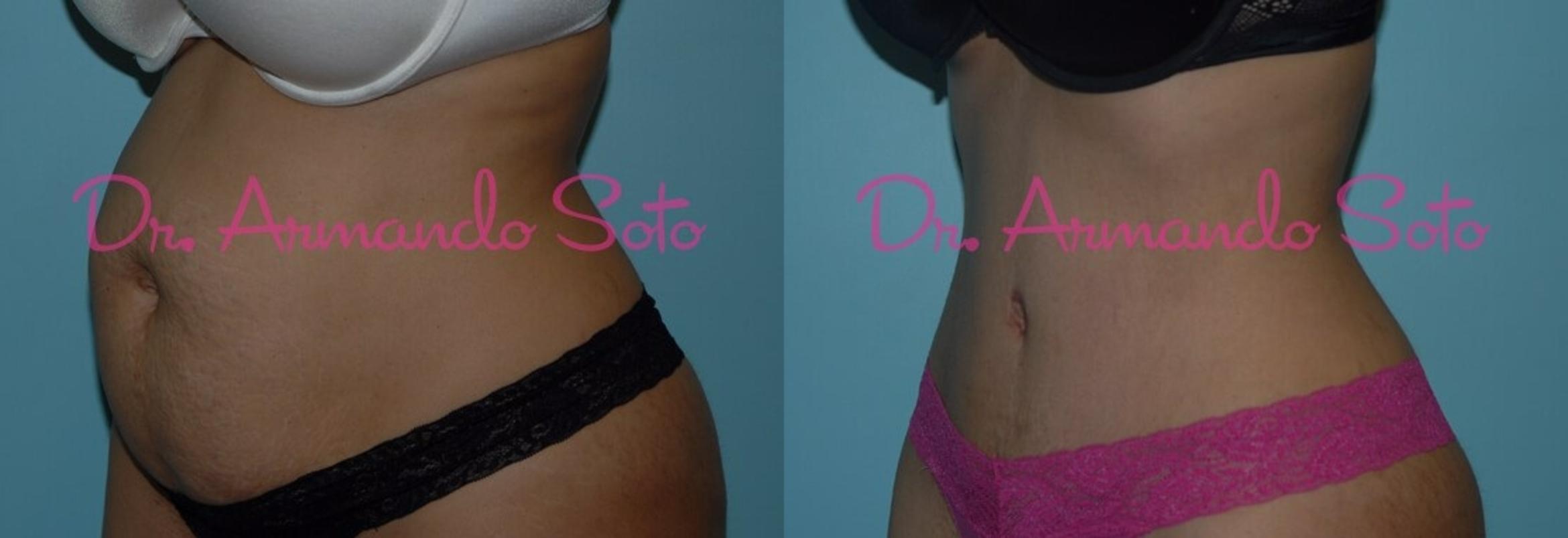 Tummy Tuck (Abdominoplasty) in Orlando, Winter Park, FL