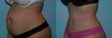 Before & After Tummy Tuck Case 23379 View #2 View in Orlando, FL
