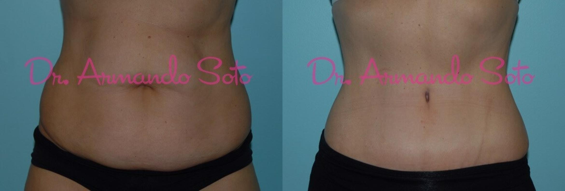 Before & After Tummy Tuck Case 23380 View #1 View in Orlando, FL