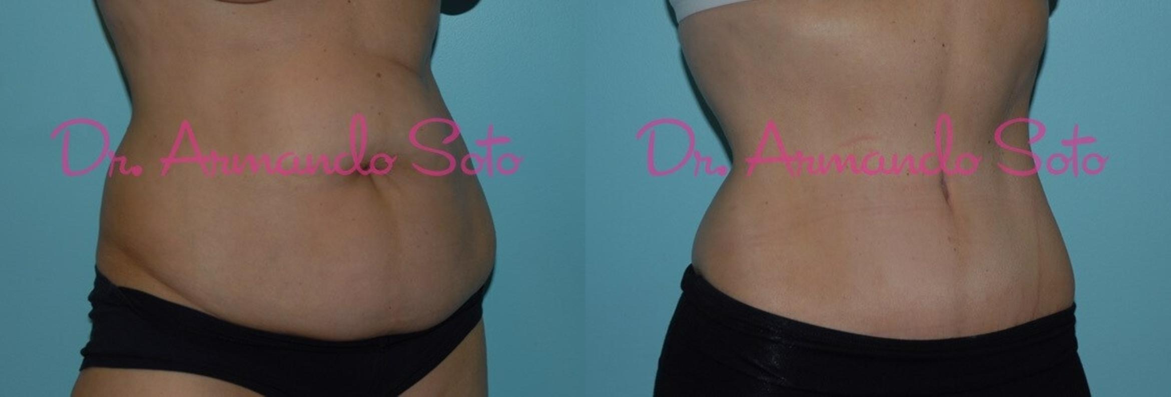 Before & After Tummy Tuck Case 23380 View #2 View in Orlando, FL