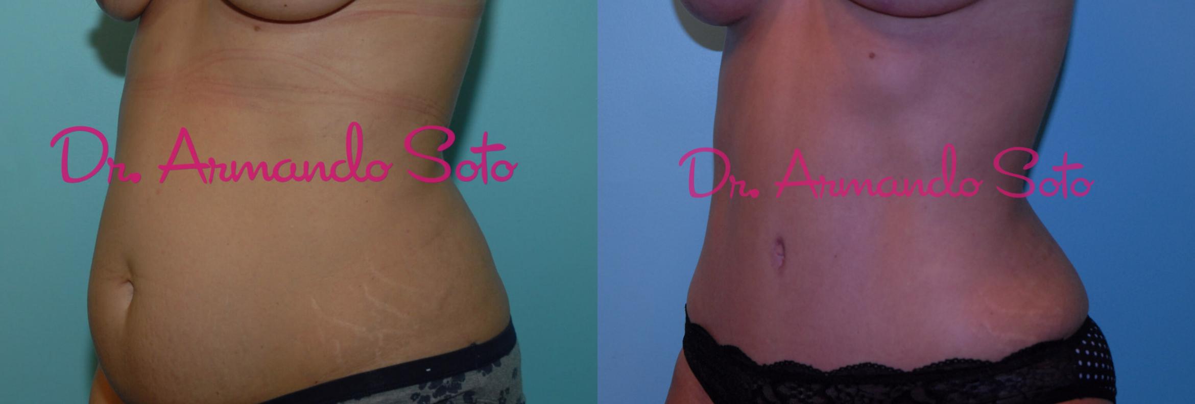 Before & After Tummy Tuck Case 23381 View #1 View in Orlando, FL