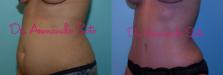 Before & After Tummy Tuck Case 23381 View #1 View in Orlando, FL