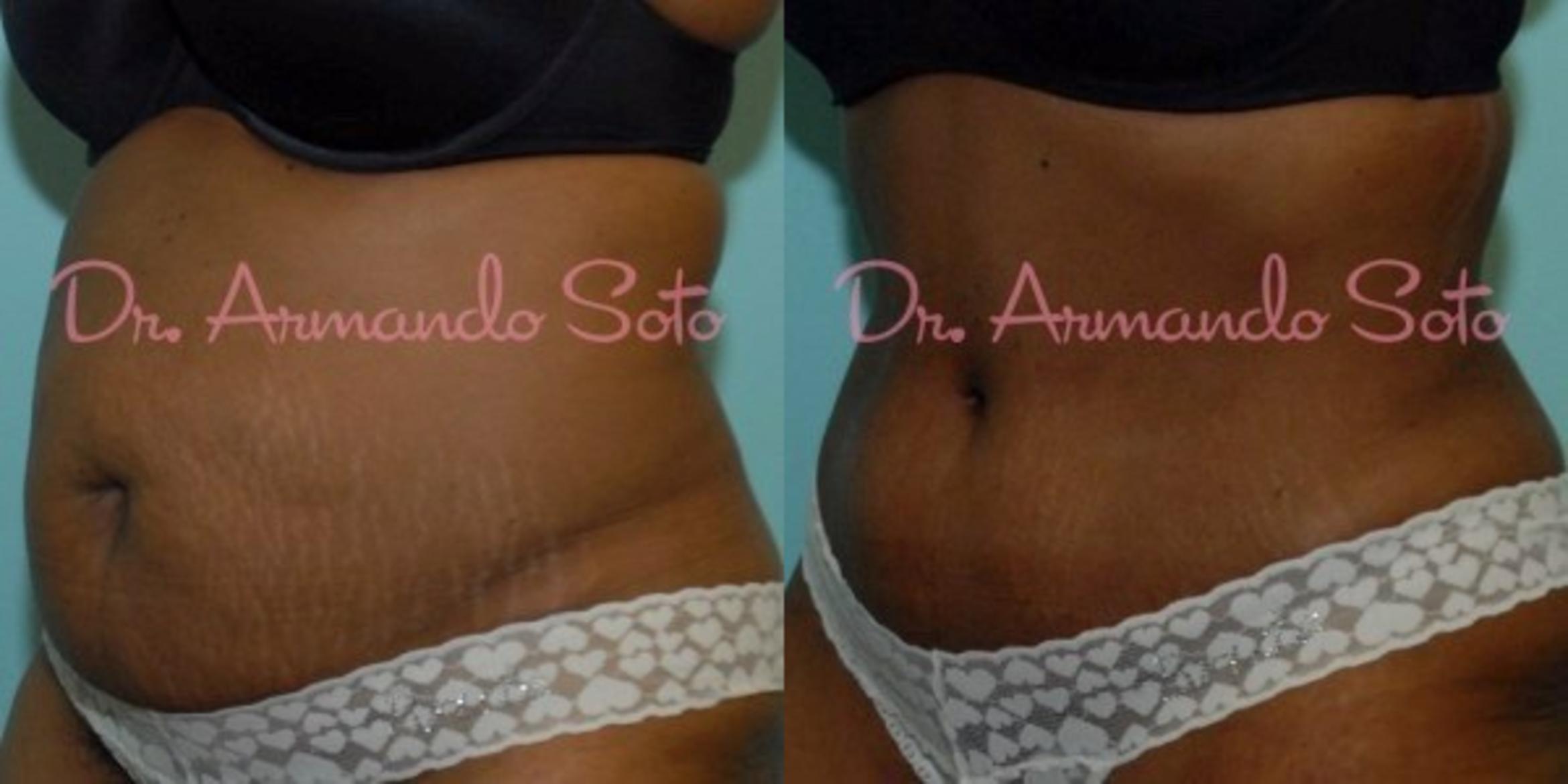 Before & After Tummy Tuck Case 23452 View #1 View in Orlando, FL