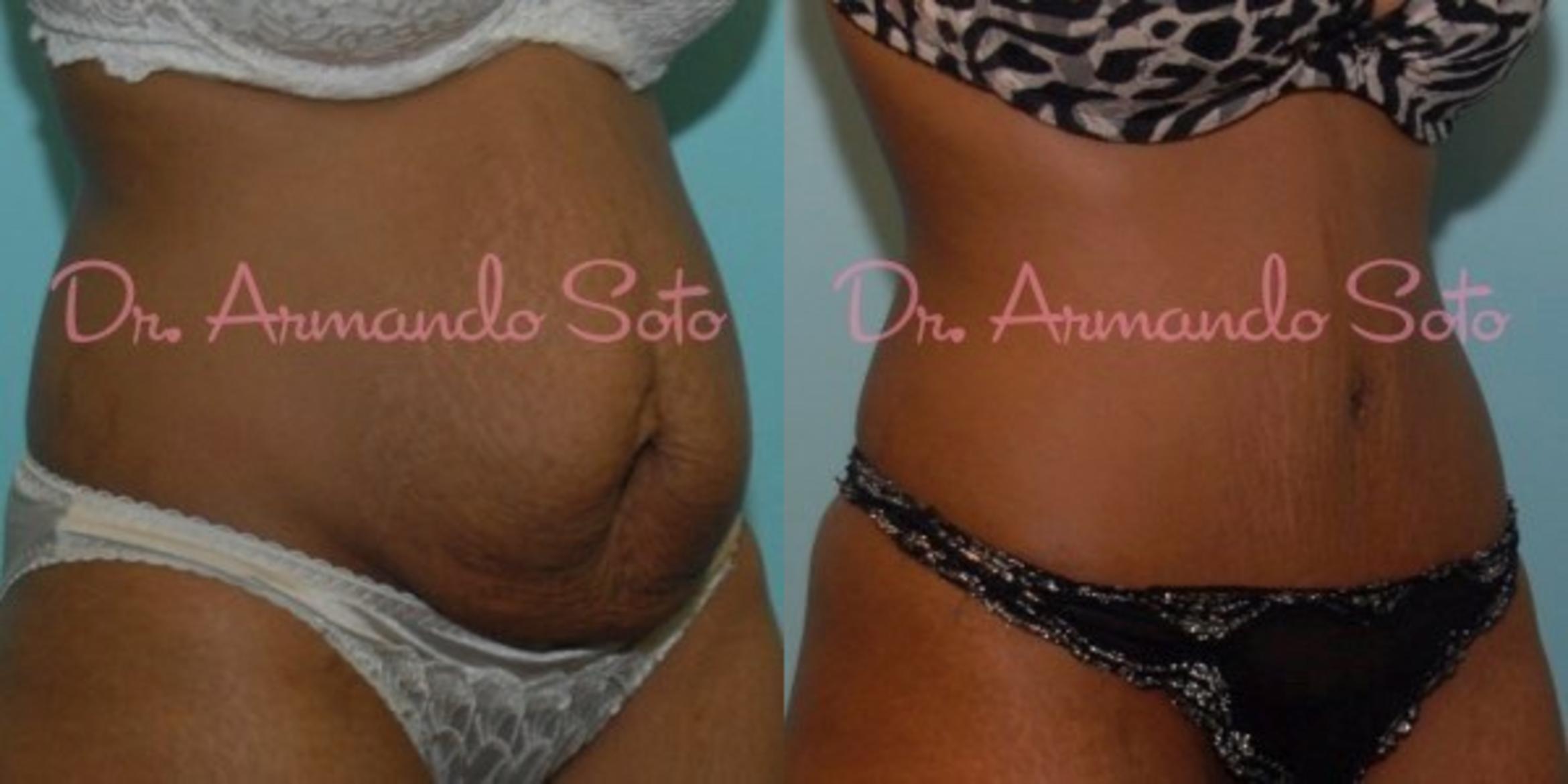 Before & After Tummy Tuck Case 23472 View #1 View in Orlando, FL