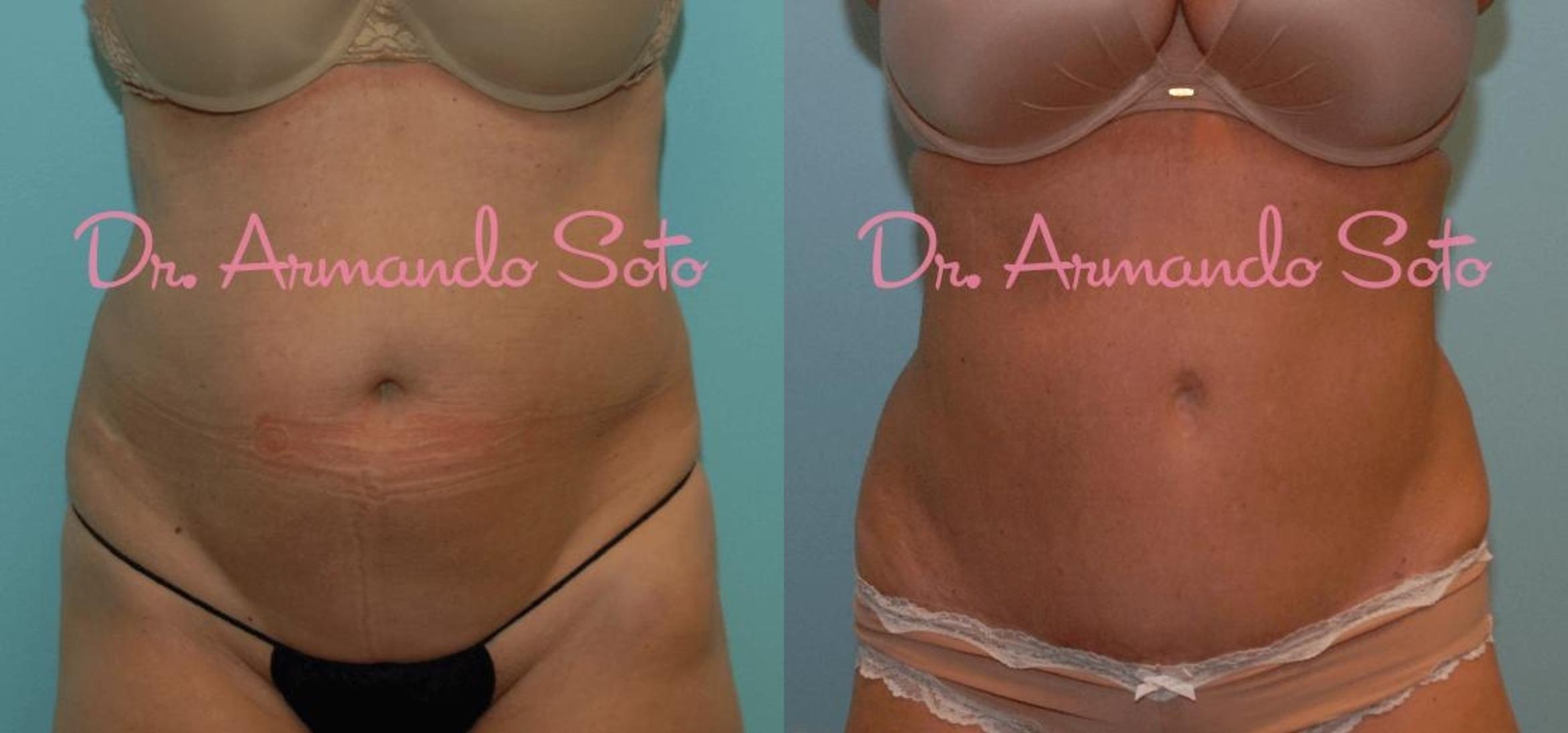 Before & After Tummy Tuck Case 23539 View #1 View in Orlando, FL