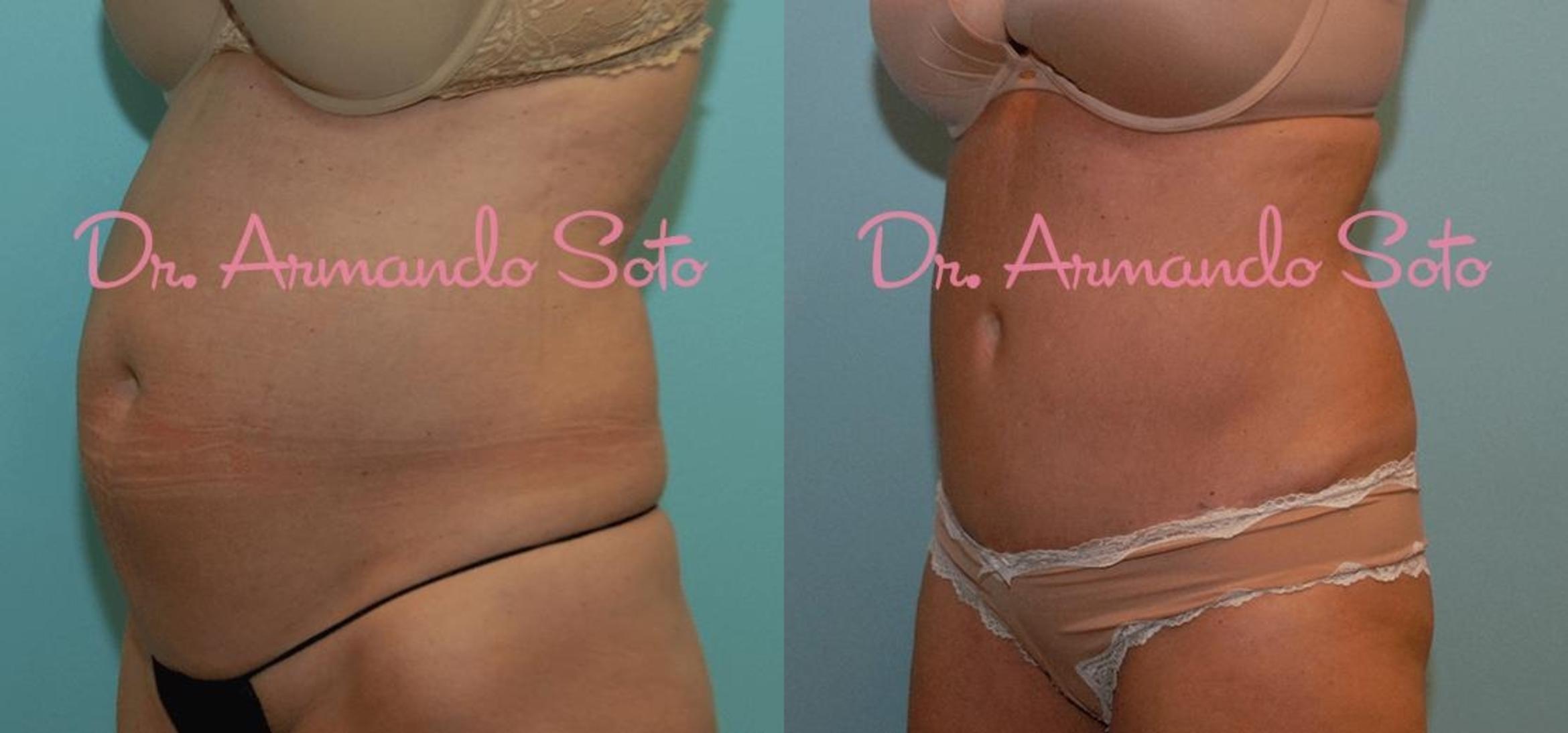 Before & After Tummy Tuck Case 23539 View #2 View in Orlando, FL