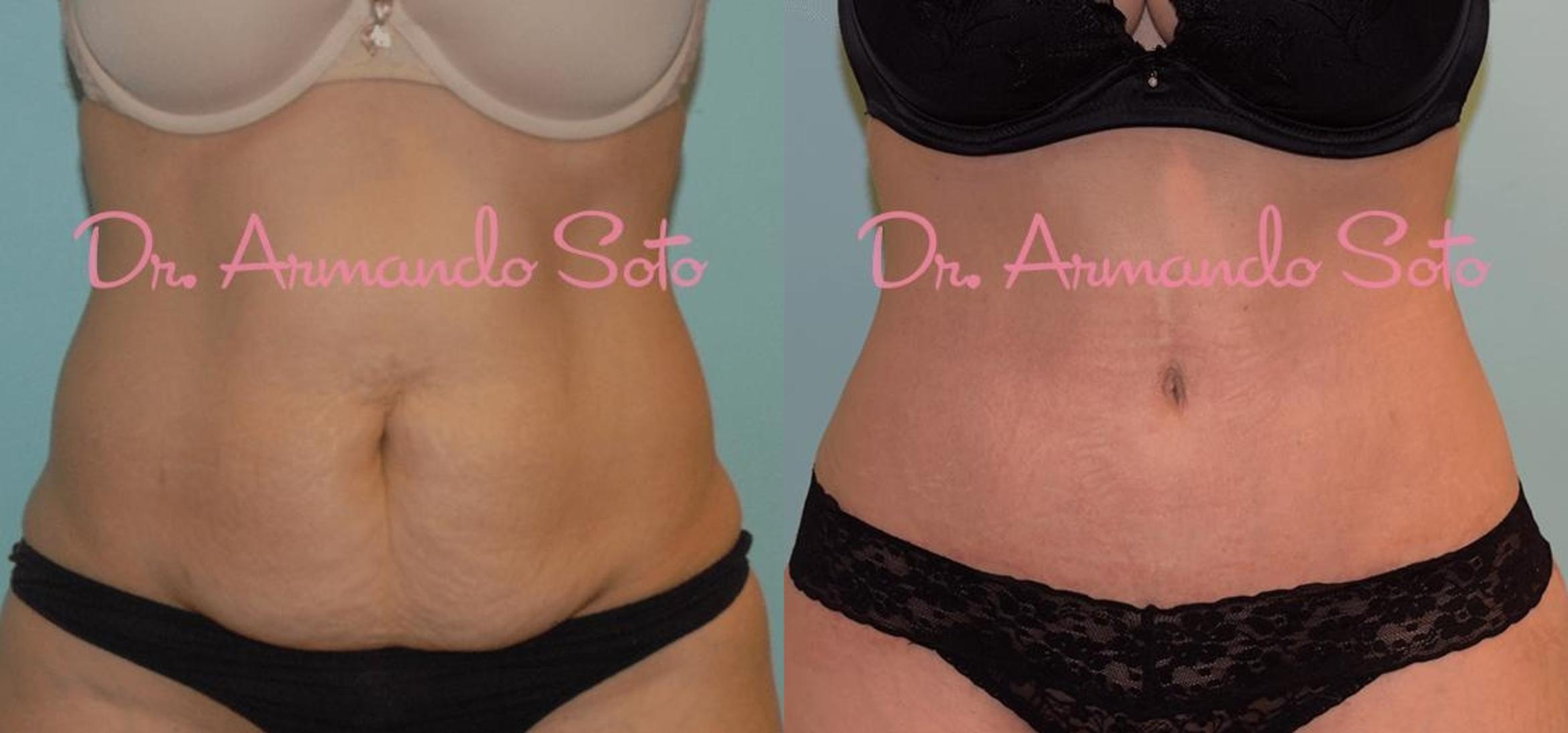 Before & After Tummy Tuck Case 23634 View #1 View in Orlando, FL