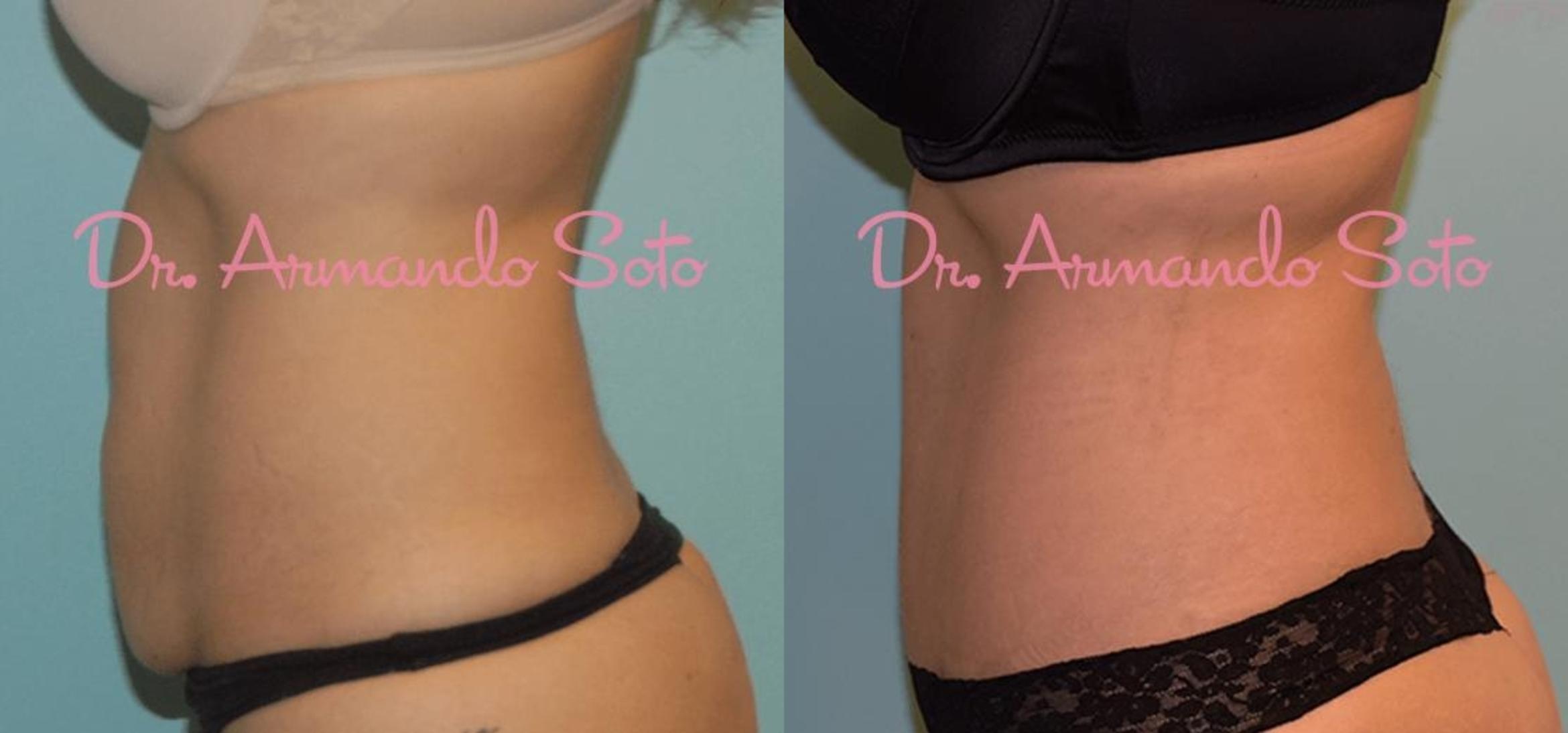 Before & After Tummy Tuck Case 23634 View #2 View in Orlando, FL