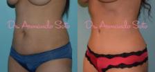 Before & After Tummy Tuck Case 23939 View #1 View in Orlando, FL