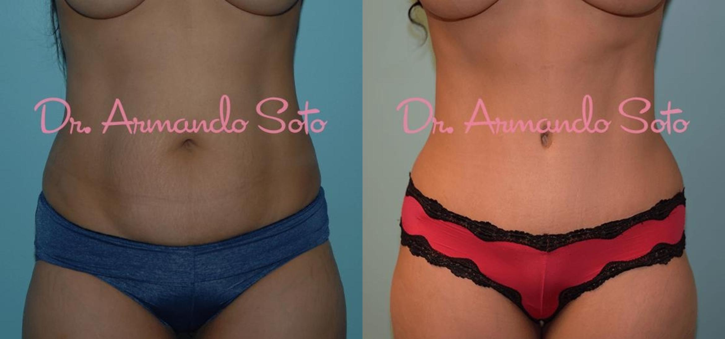 Before & After Tummy Tuck Case 23939 View #2 View in Orlando, FL