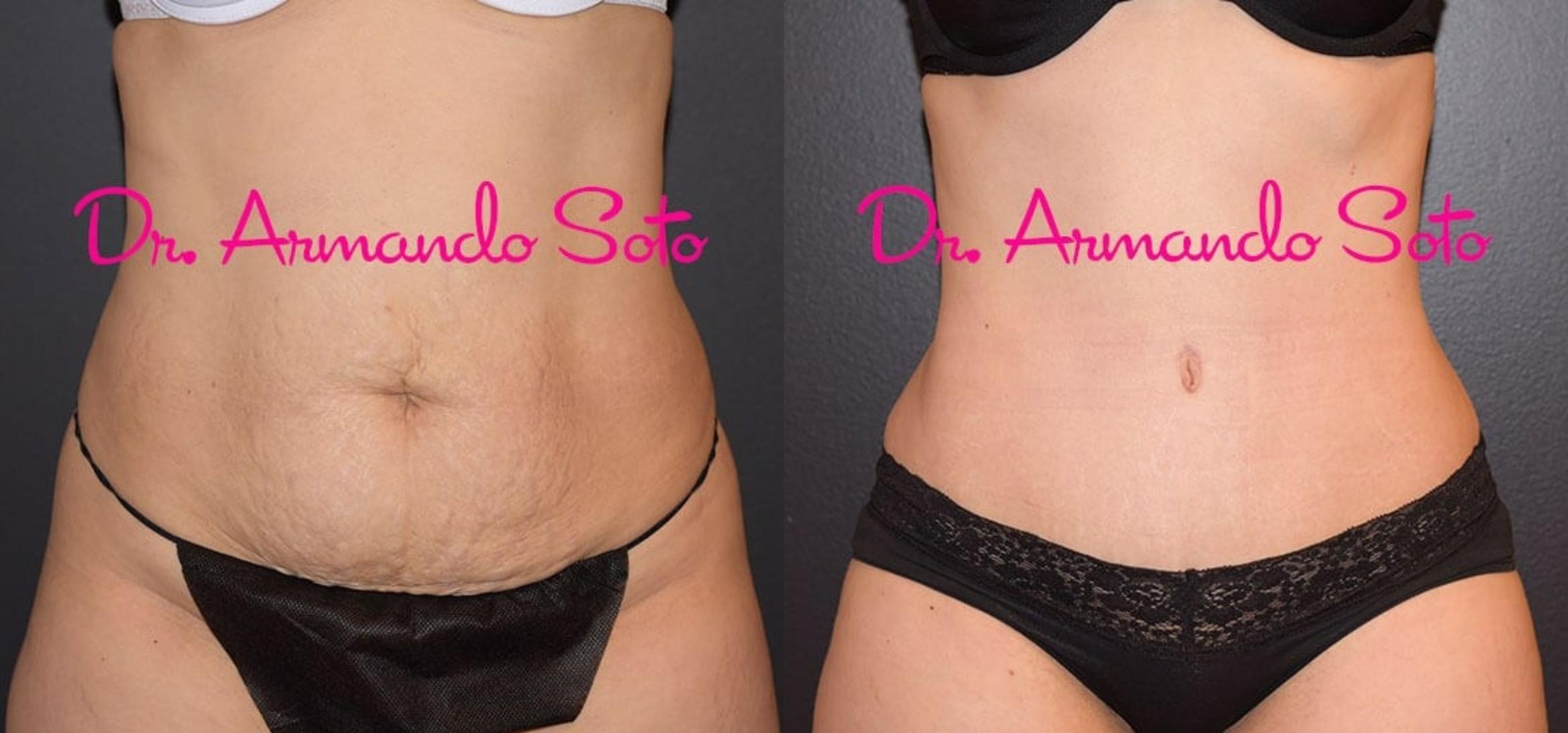 Before & After Tummy Tuck Case 31901 View #1 View in Orlando, FL