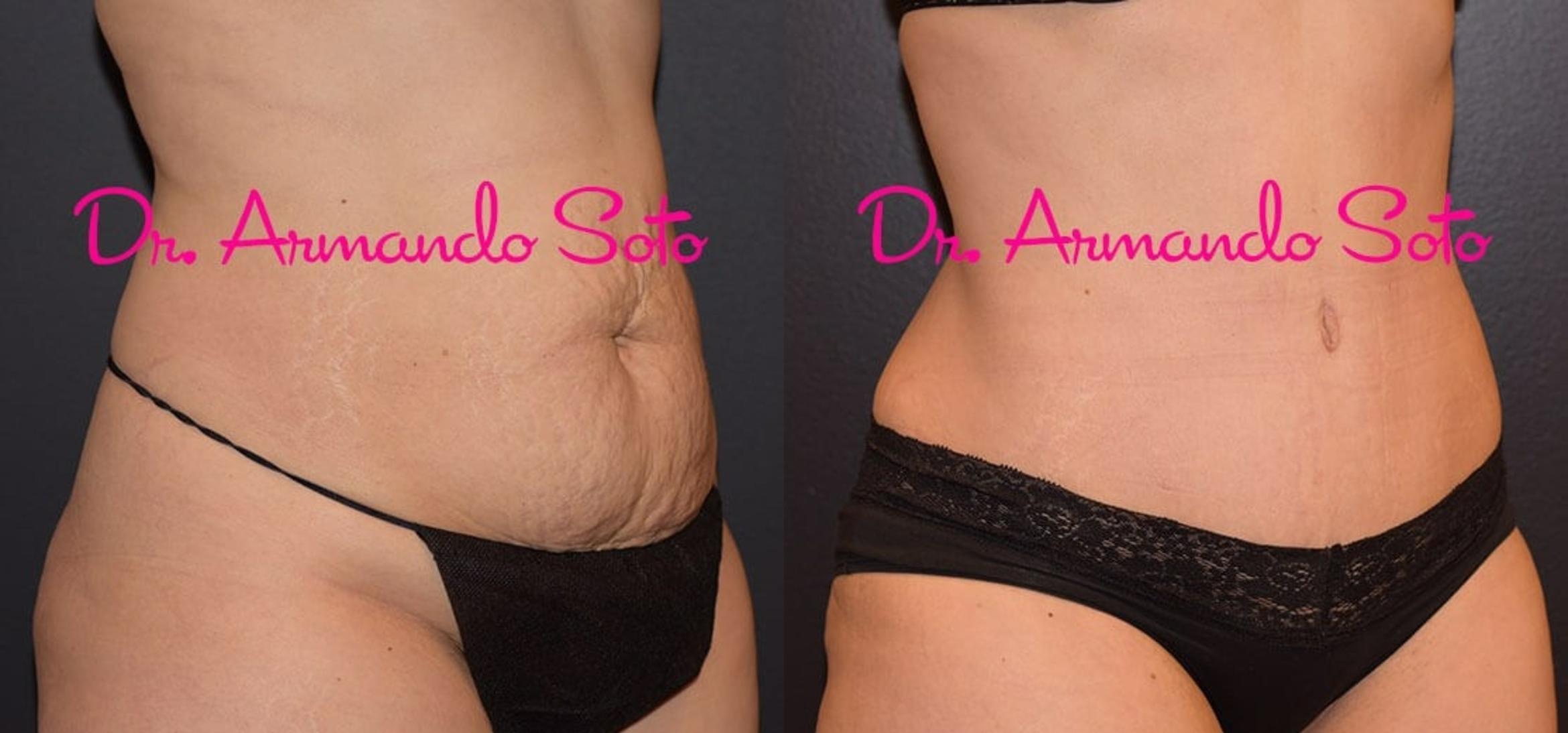 Before & After Tummy Tuck Case 31901 View #2 View in Orlando, FL