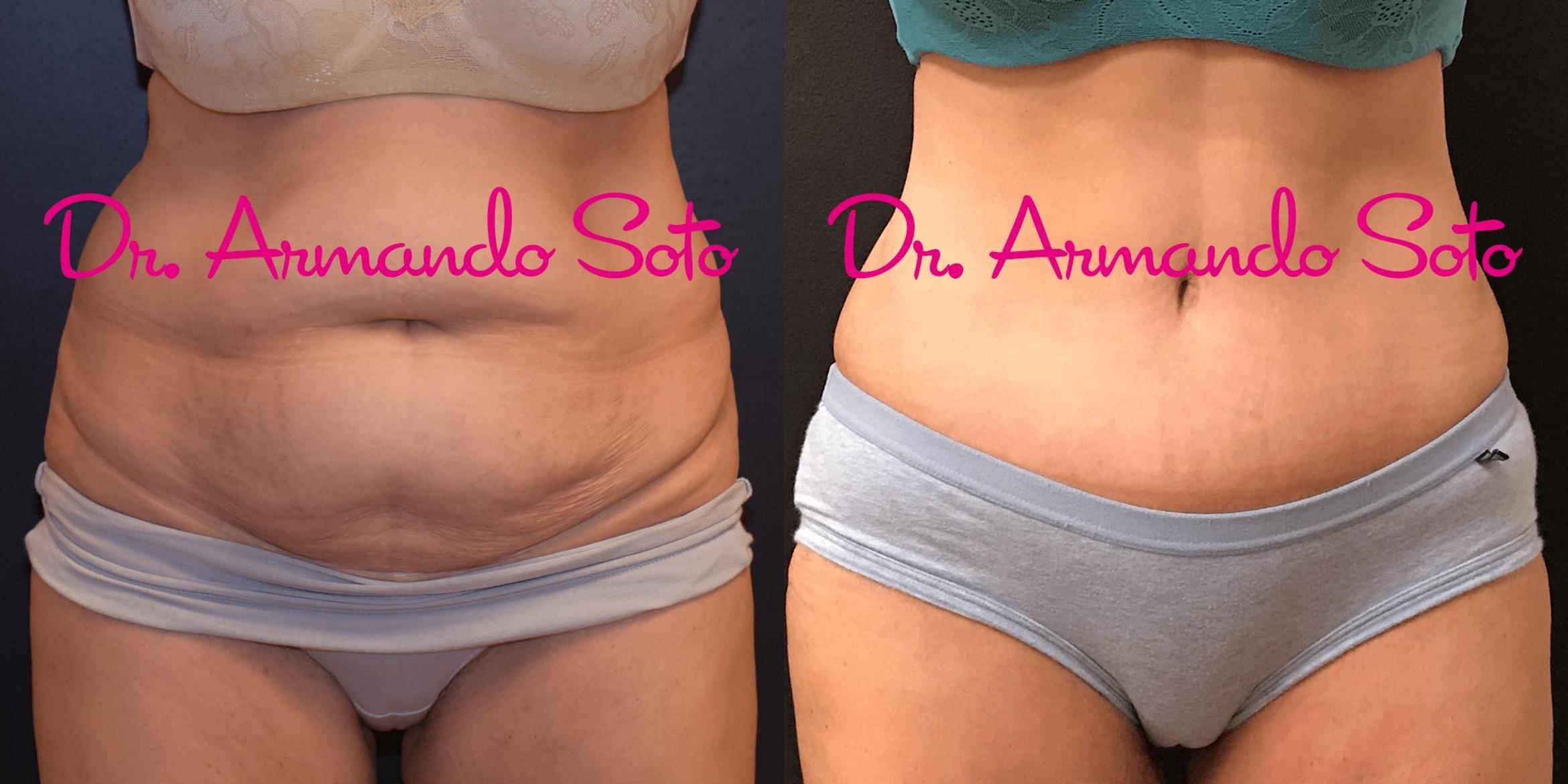 Before & After Tummy Tuck Case 69060 View #1 View in Orlando, FL