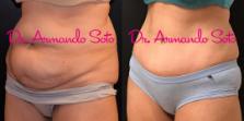 Before & After Tummy Tuck Case 69060 View #2 View in Orlando, FL