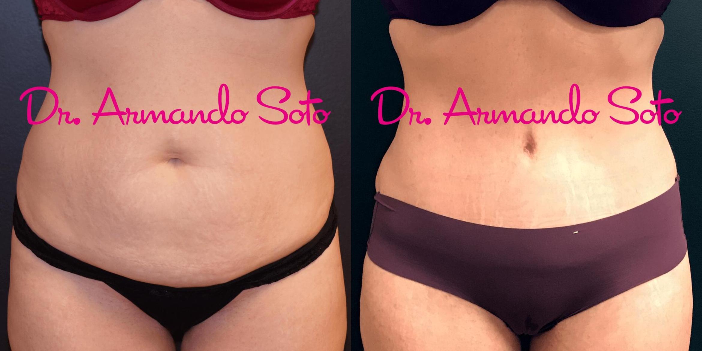 How to Get a Flat Tummy: Tummy Tuck vs. Liposuction vs. SculpSure® in  Westchester, NY