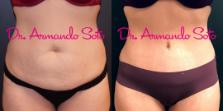 Before & After Tummy Tuck Case 69073 View #1 View in Orlando, FL