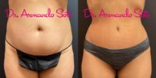 Before & After Tummy Tuck Case 73251 View #1 View in Orlando, FL