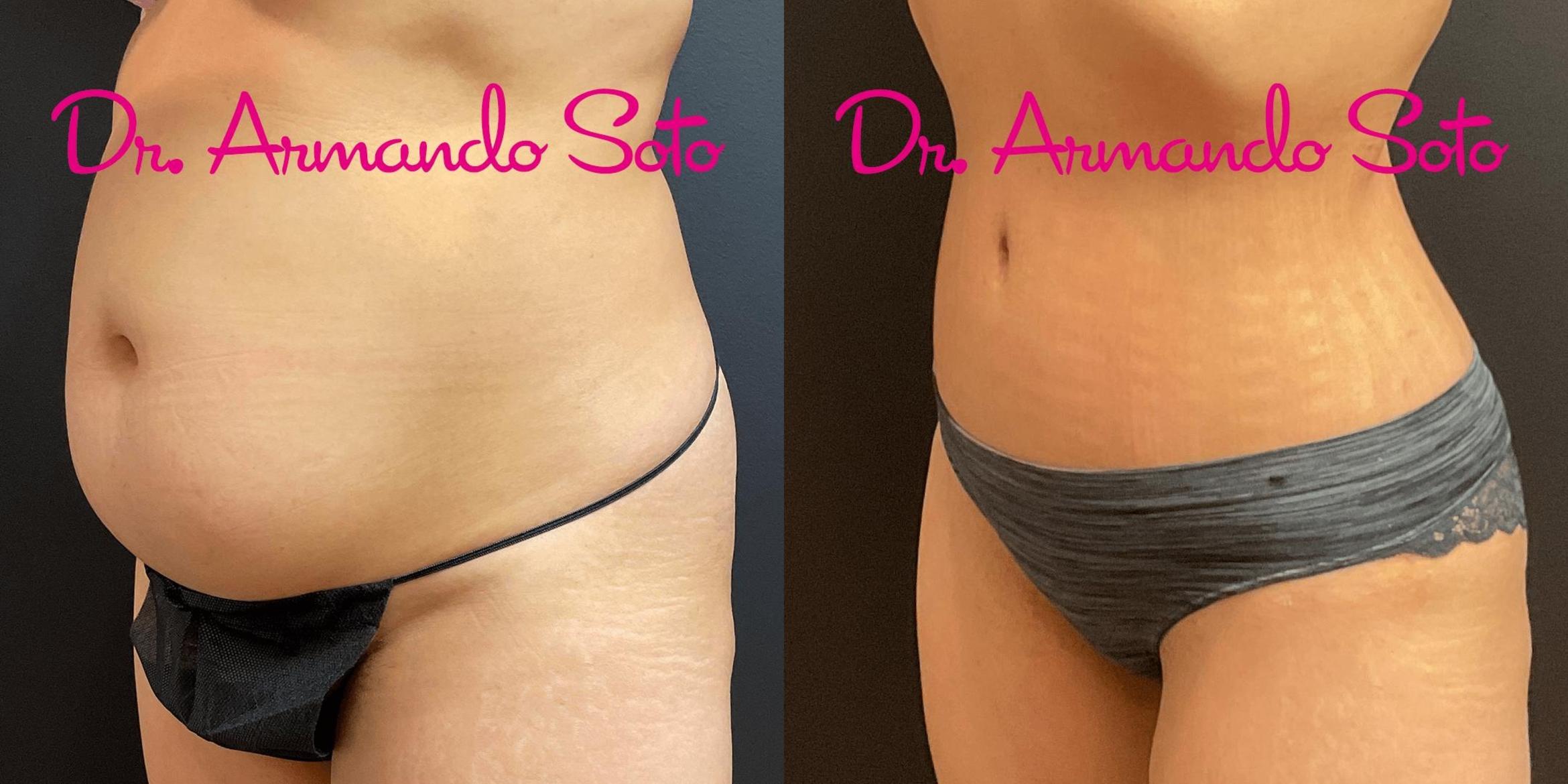 Before & After Tummy Tuck Case 73251 View #2 View in Orlando, FL