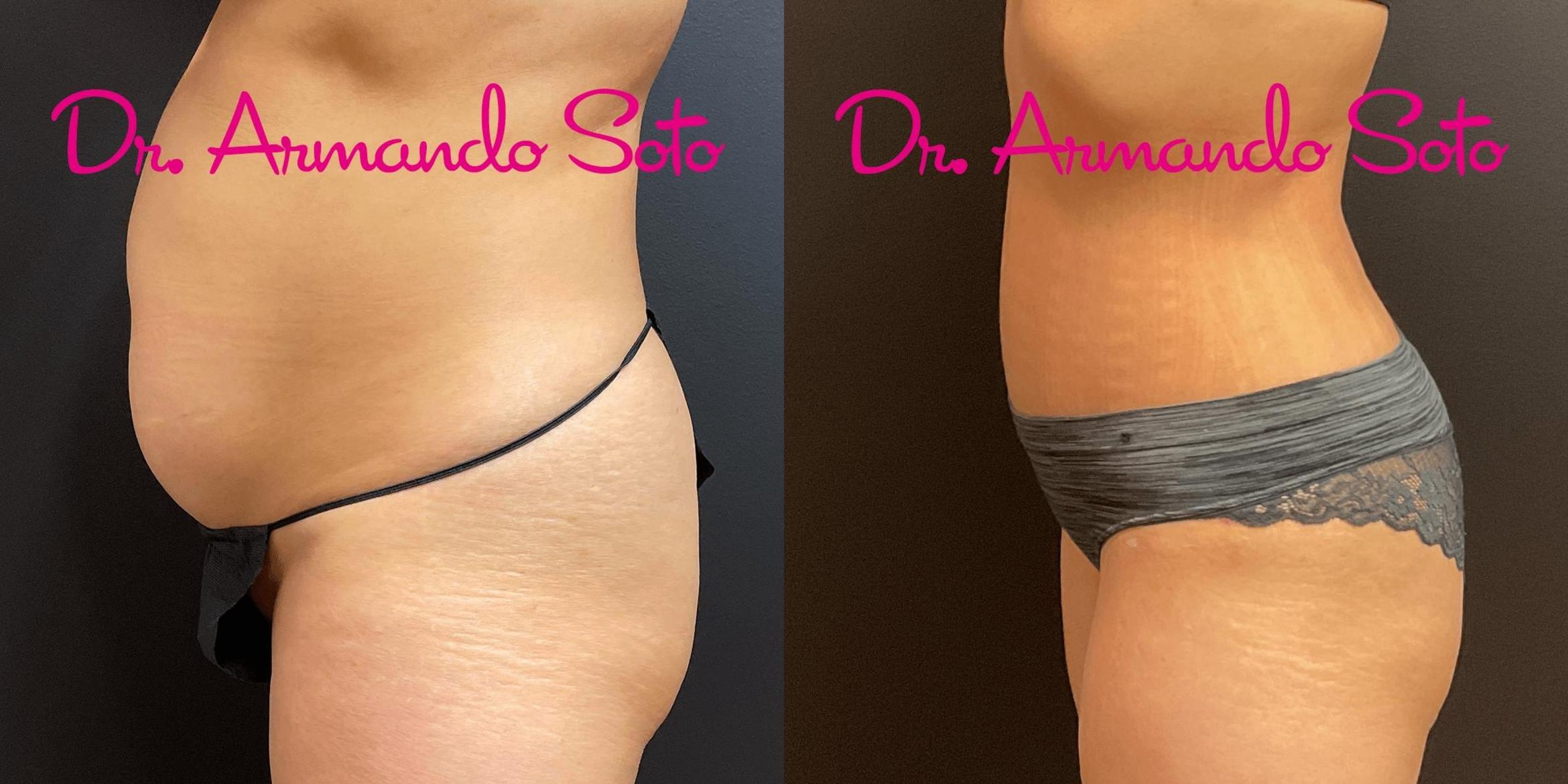 Before & After Tummy Tuck Case 73251 View #3 View in Orlando, FL