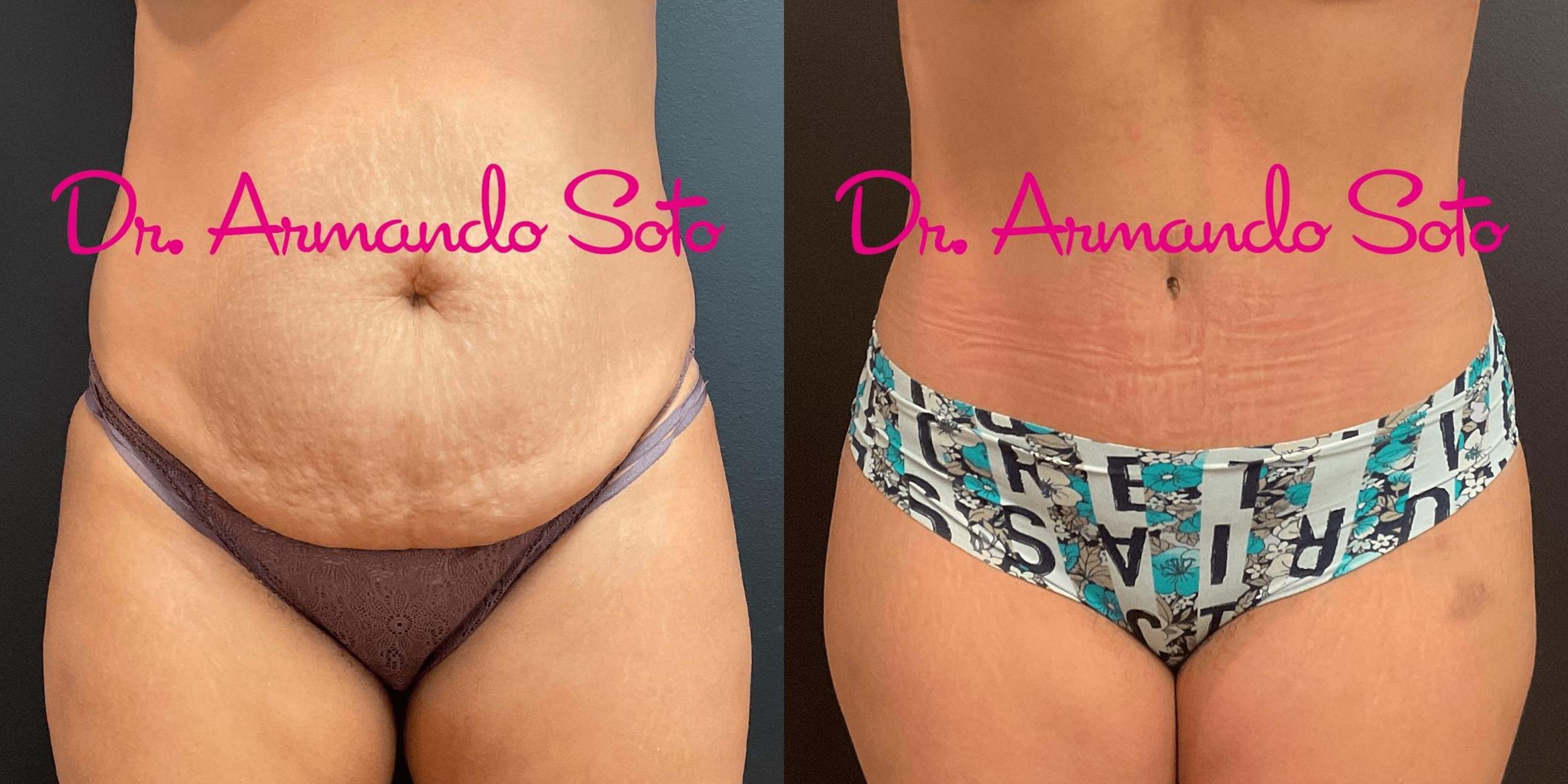 Before & After Tummy Tuck Case 73607 View #1 View in Orlando, FL