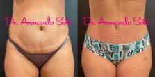 Before & After Tummy Tuck Case 73607 View #1 View in Orlando, FL