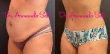 Before & After Tummy Tuck Case 73607 View #2 View in Orlando, FL