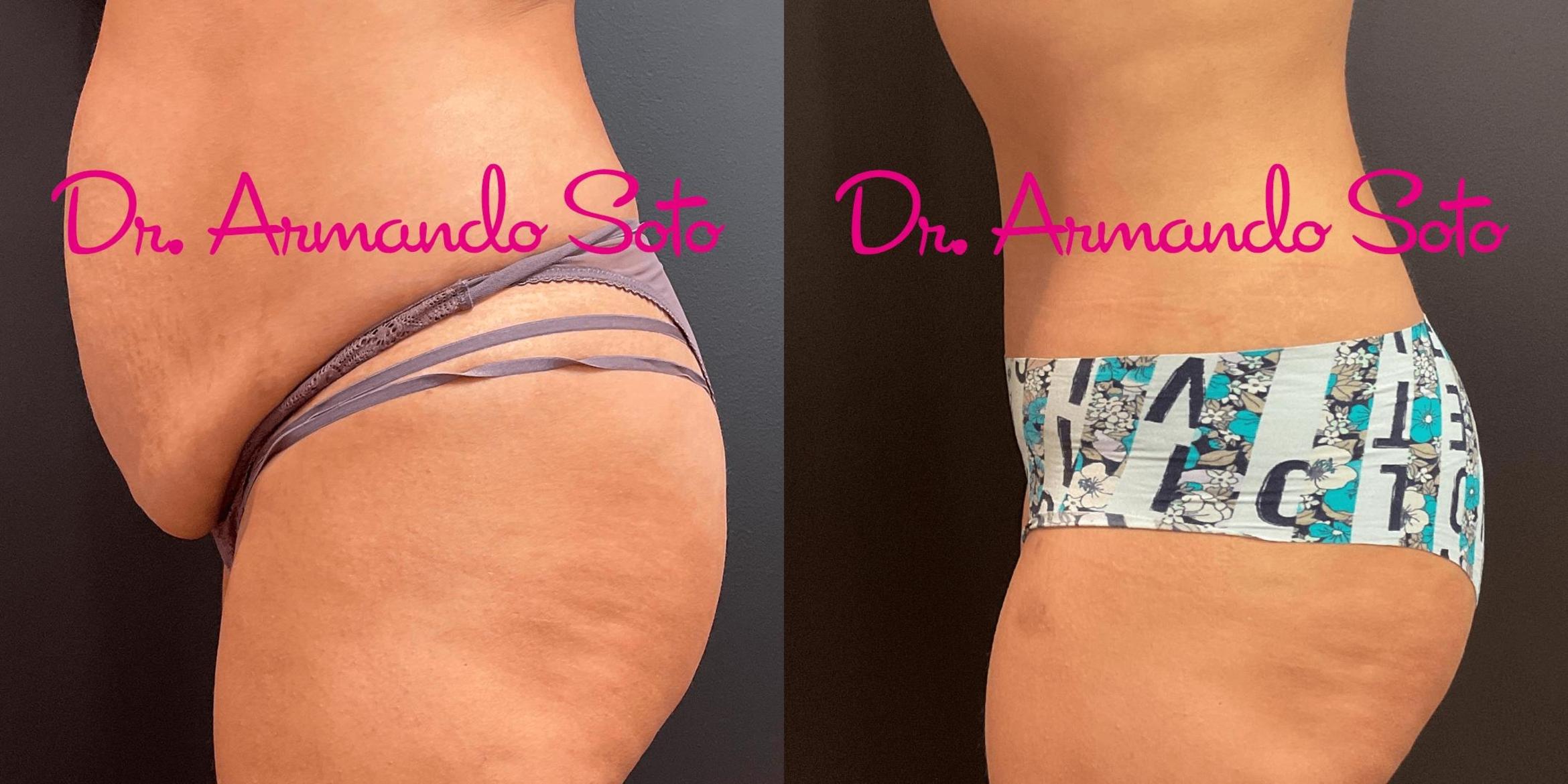 Before & After Tummy Tuck Case 73607 View #3 View in Orlando, FL