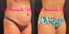 Before & After Tummy Tuck Case 73607 View #4 View in Orlando, FL