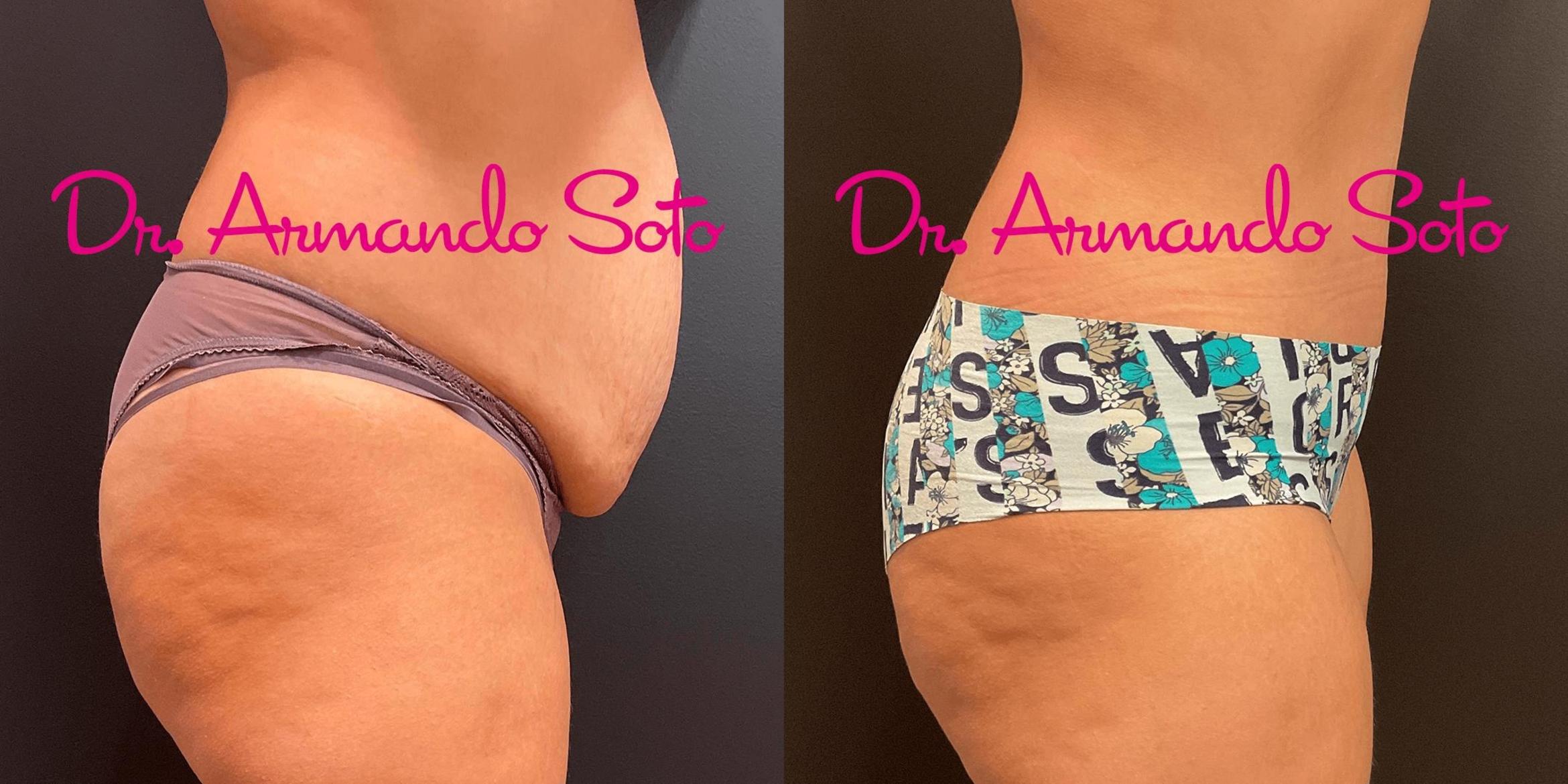 Mini Tummy Tuck Surgery, Gainesville, FL