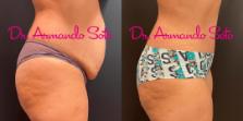 Before & After Tummy Tuck Case 73607 View #5 View in Orlando, FL