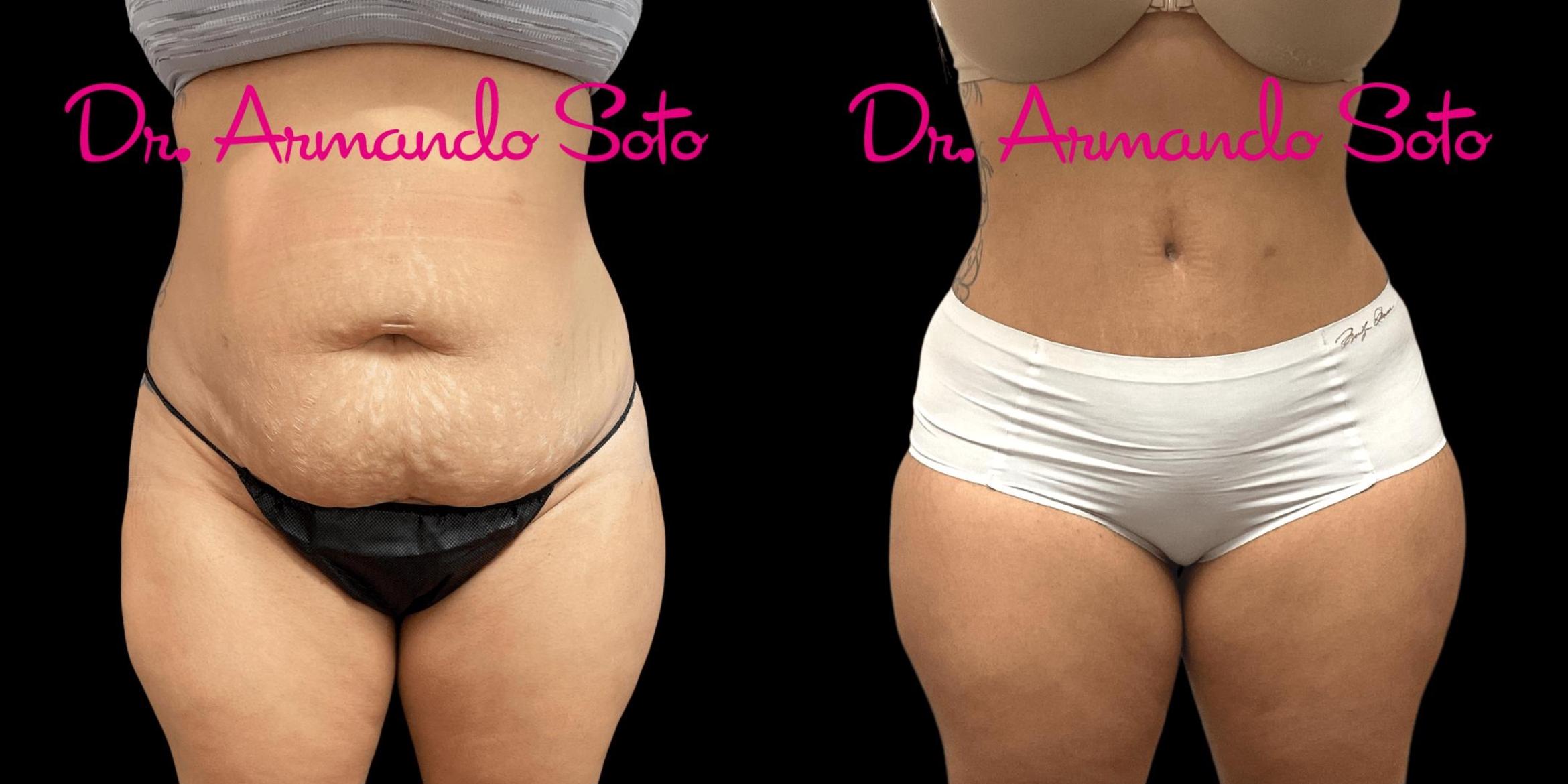 Before & After Tummy Tuck Case 74976 View #1 View in Orlando, FL