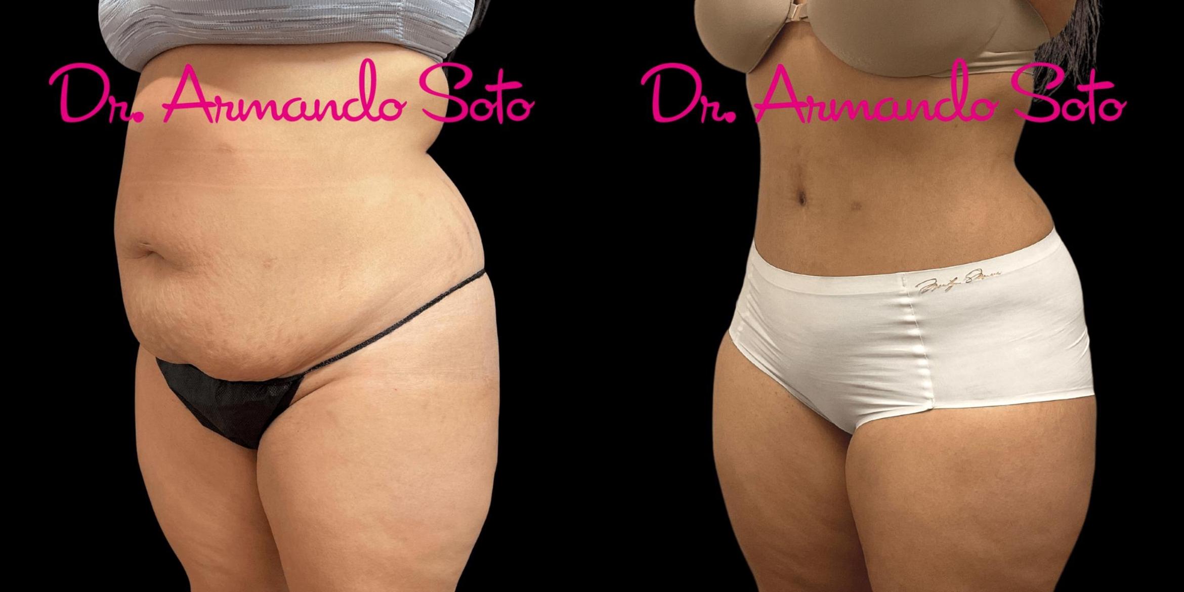 Mini Tummy Tuck Before & After Photos Fort Lauderdale, Coral Springs