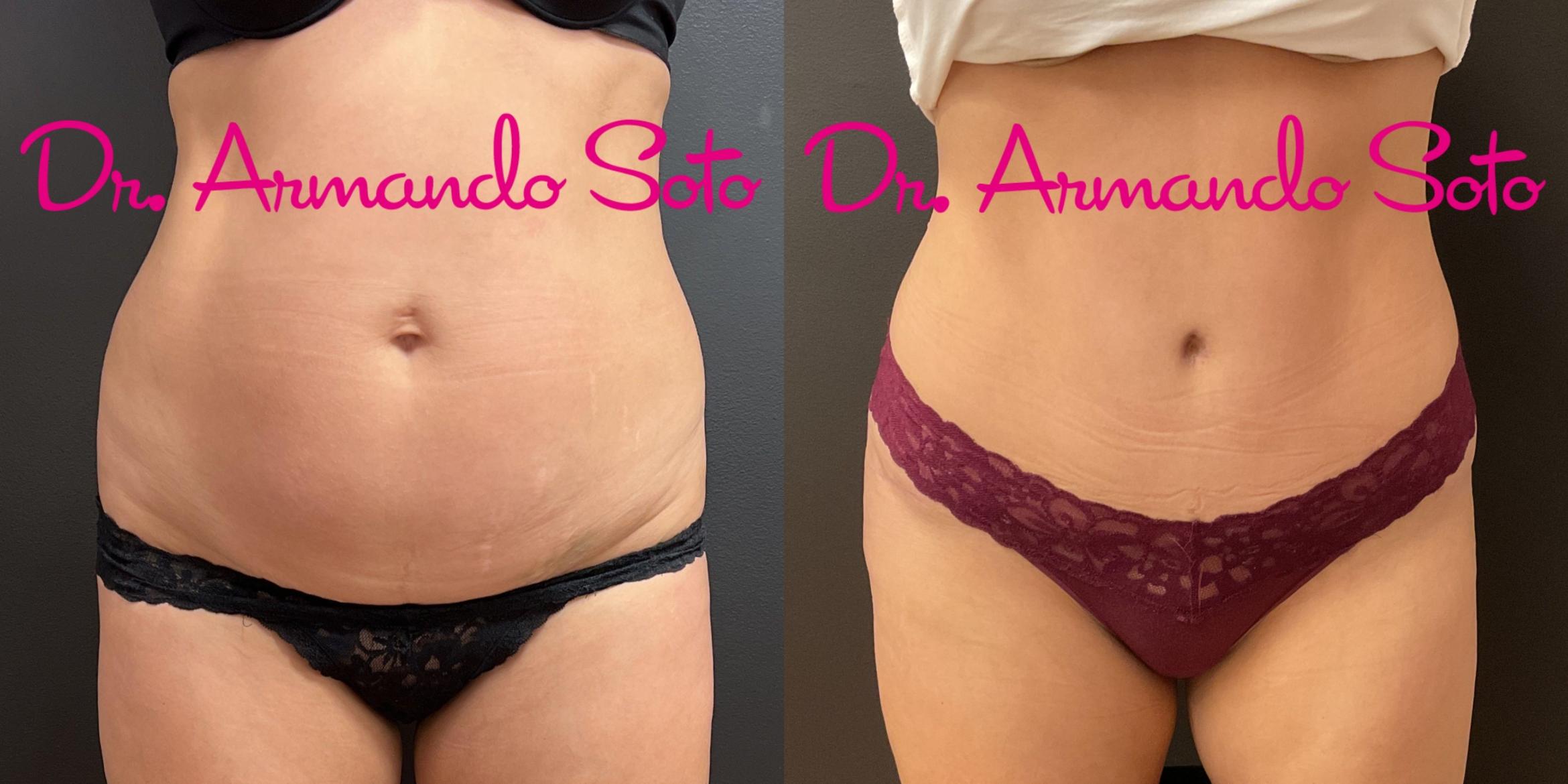 Before & After Tummy Tuck Case 76273 Front View in Orlando, FL