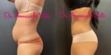 Before & After Tummy Tuck Case 76294 Left Side View in Orlando, FL