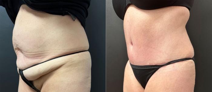 Before & After Tummy Tuck Case 76338 Left Side View in Orlando, FL