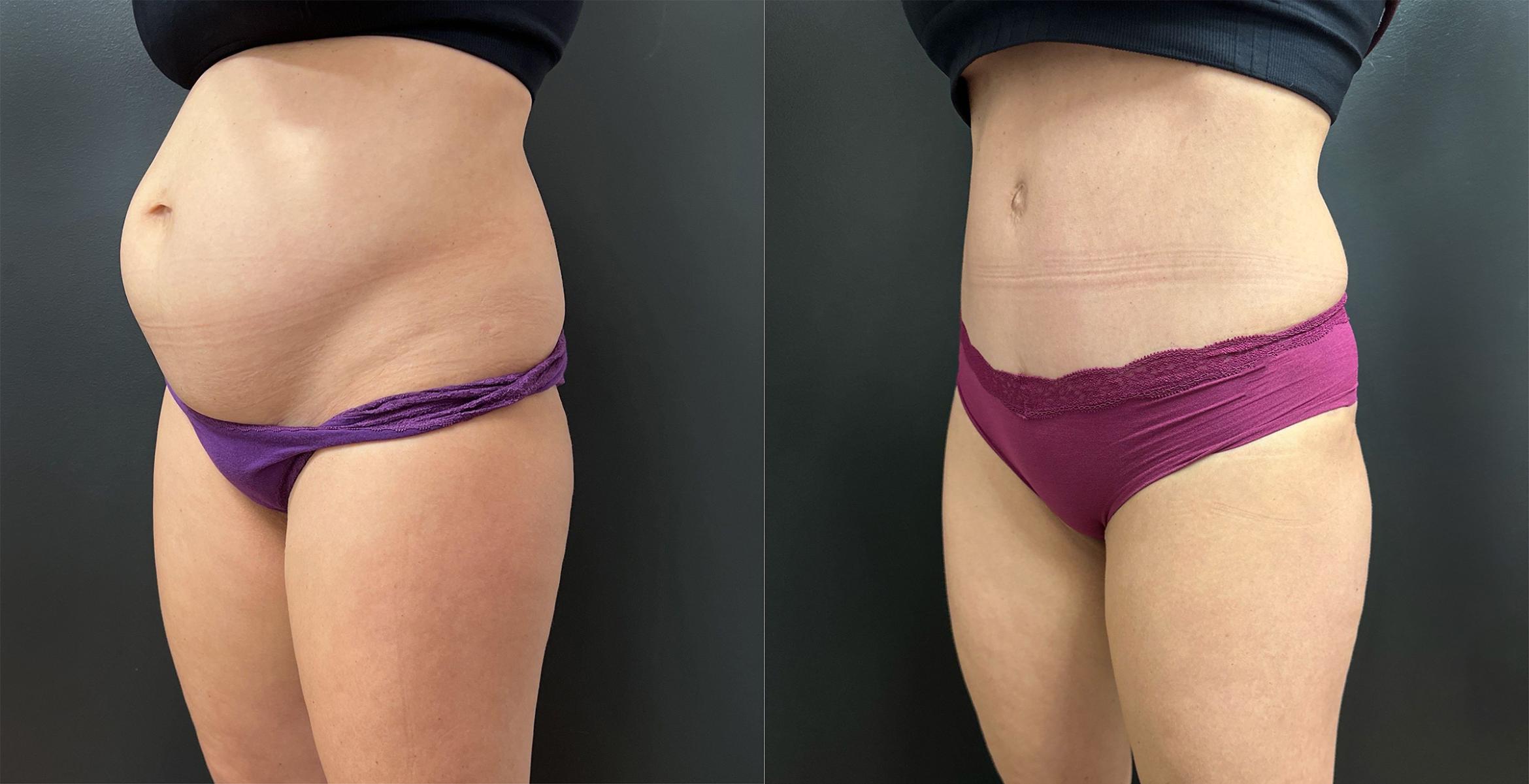 Before & After Tummy Tuck Case 76339 Left Side View in Orlando, FL