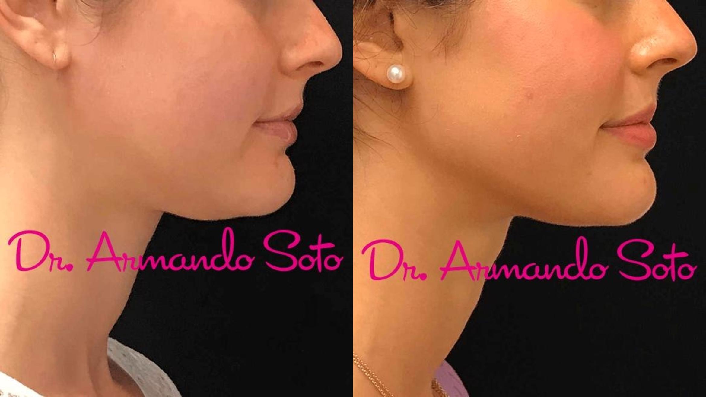 Before & After Ultherapy Case 67257 View #1 View in Orlando, FL