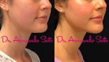 Before & After Ultherapy Case 67257 View #2 View in Orlando, FL
