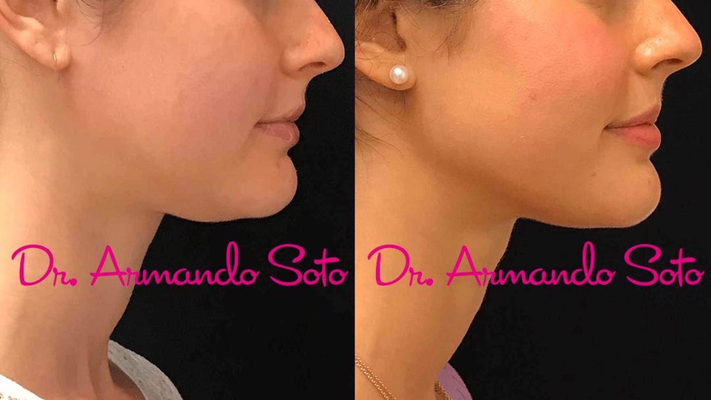 Before & After Ultherapy Case 71947 View #1 View in Orlando, FL