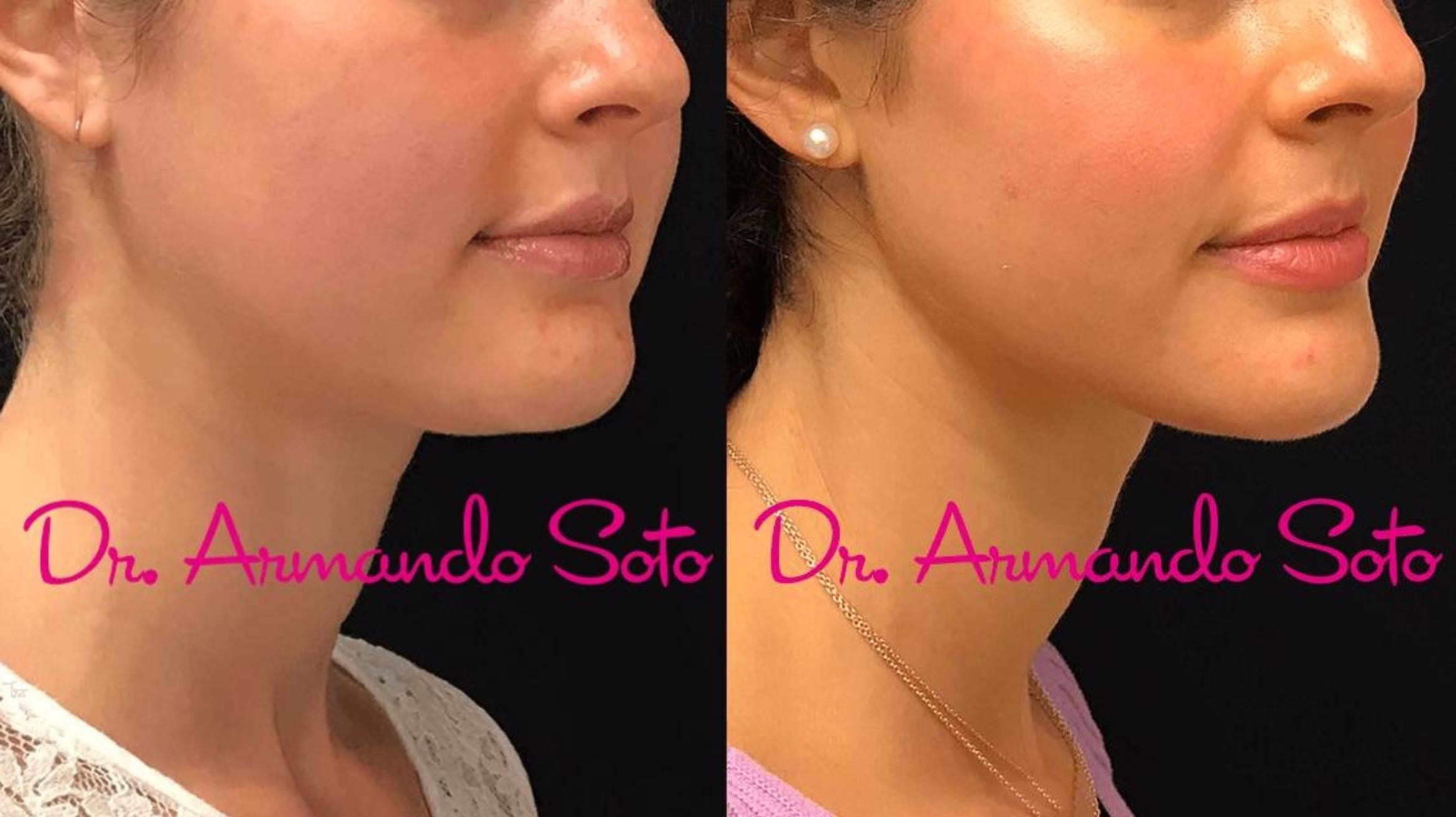Before & After Ultherapy Case 71947 View #2 View in Orlando, FL