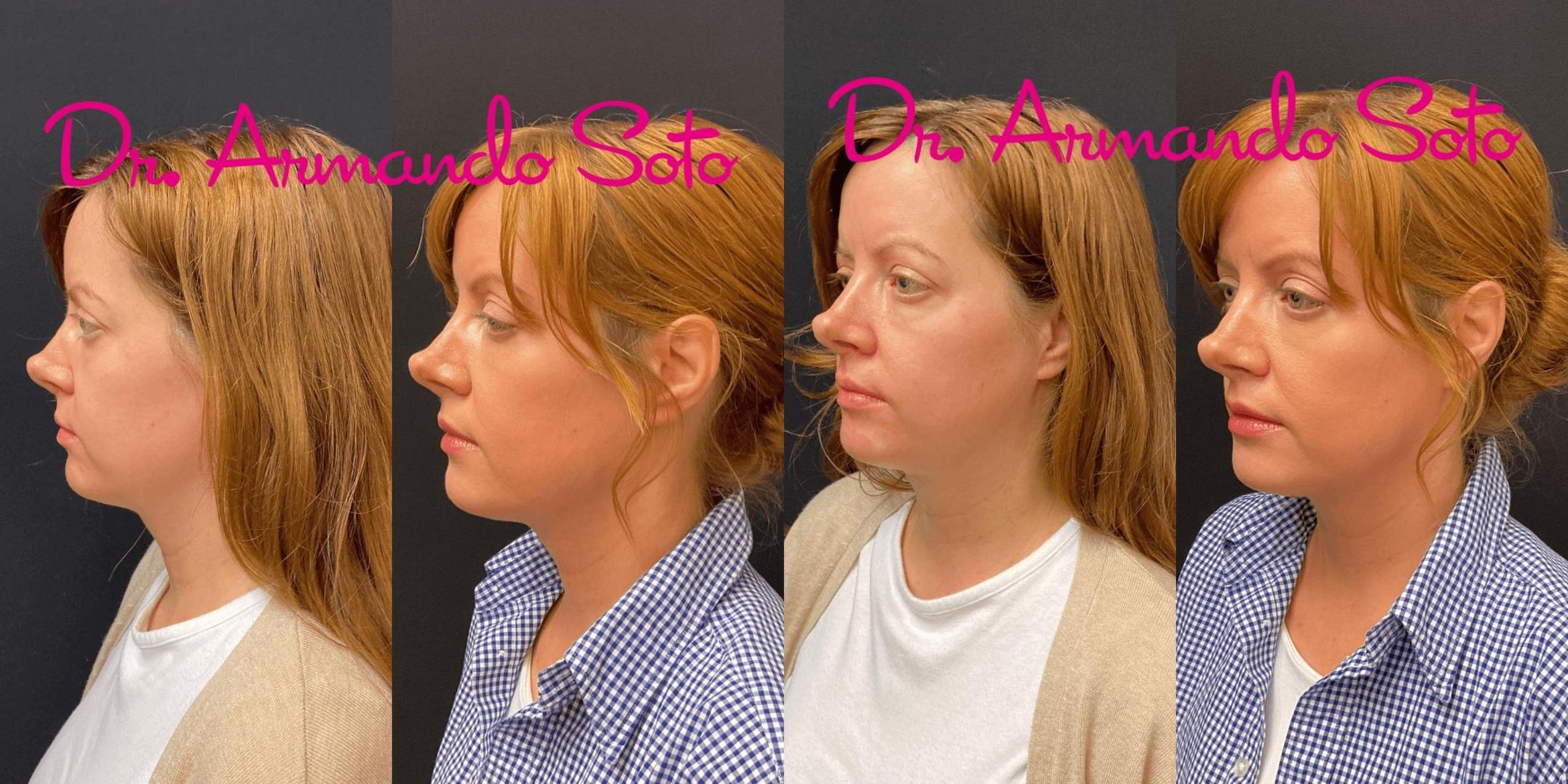 Before & After Ultherapy Case 75486 View #1 View in Orlando, FL