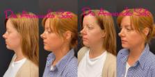 Before & After Ultherapy Case 75486 View #1 View in Orlando, FL