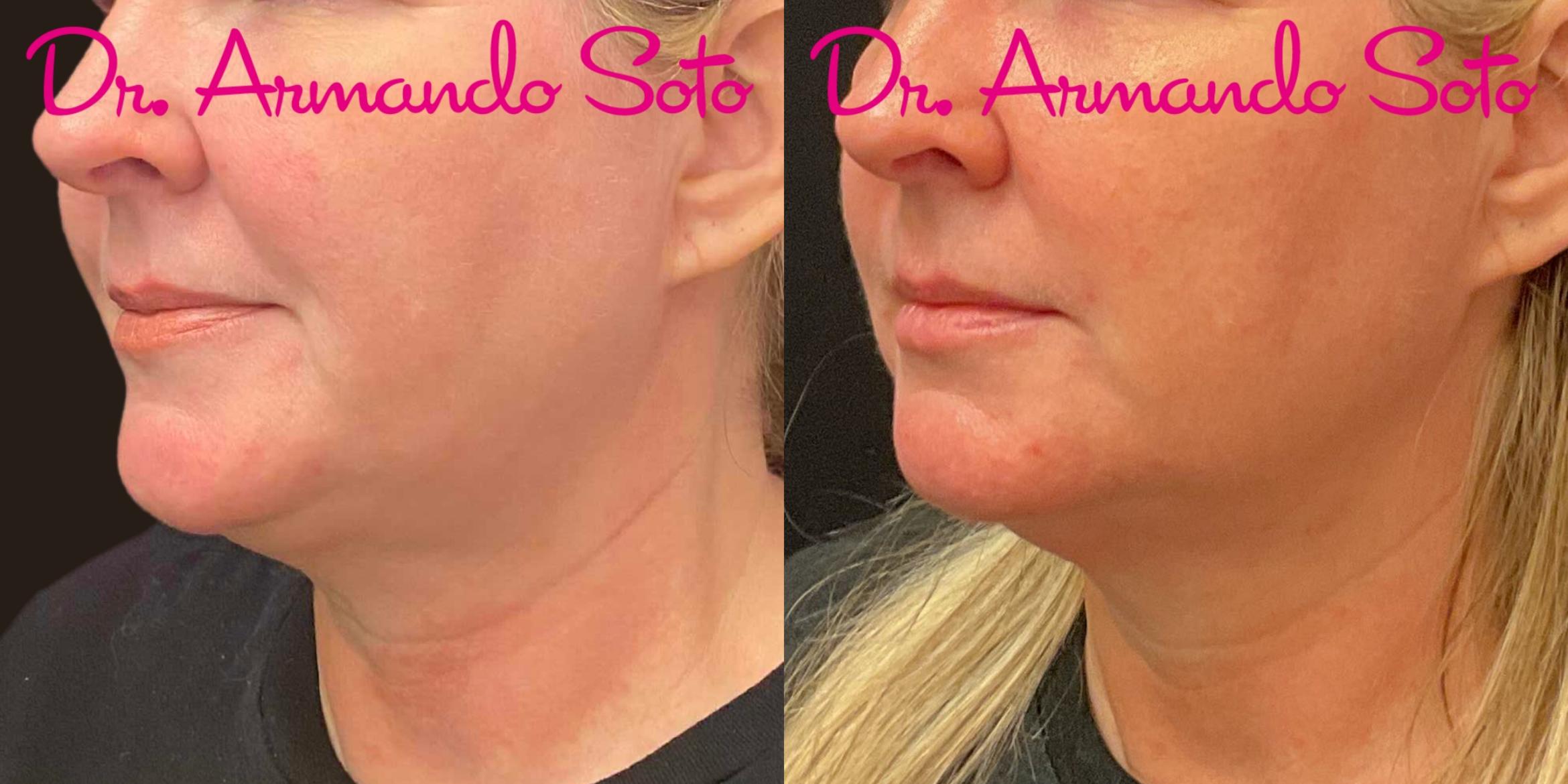 Before and After Ultherapy Treatment done by Dr. Armando Soto out of Aesthetic  Enhancements Plastic Surgery and Laser Center