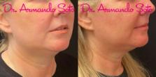 Before & After Ultherapy Case 76284 Right Side View in Orlando, FL